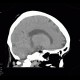 Lipoma, parasellar: CT - Computed tomography